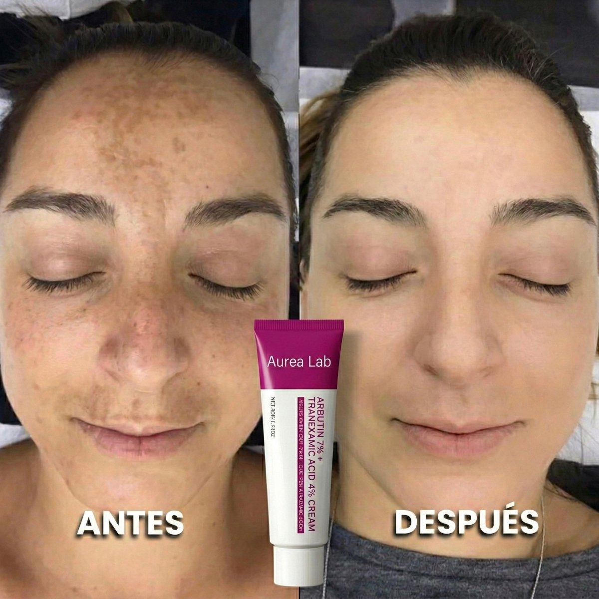 Bálsamo Anti Melasma. Reduce manchas en 7 días - Aurea Lab