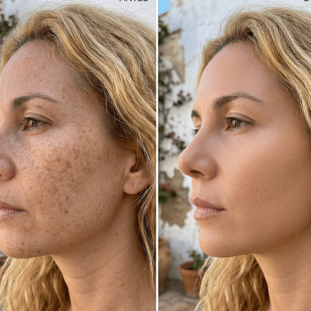 Bálsamo Anti Melasma. Reduce manchas en 7 días - Aurea Lab