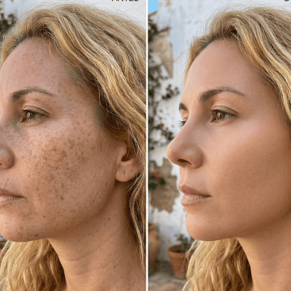 Bálsamo Anti Melasma. Reduce manchas en 7 días - Aurea Lab