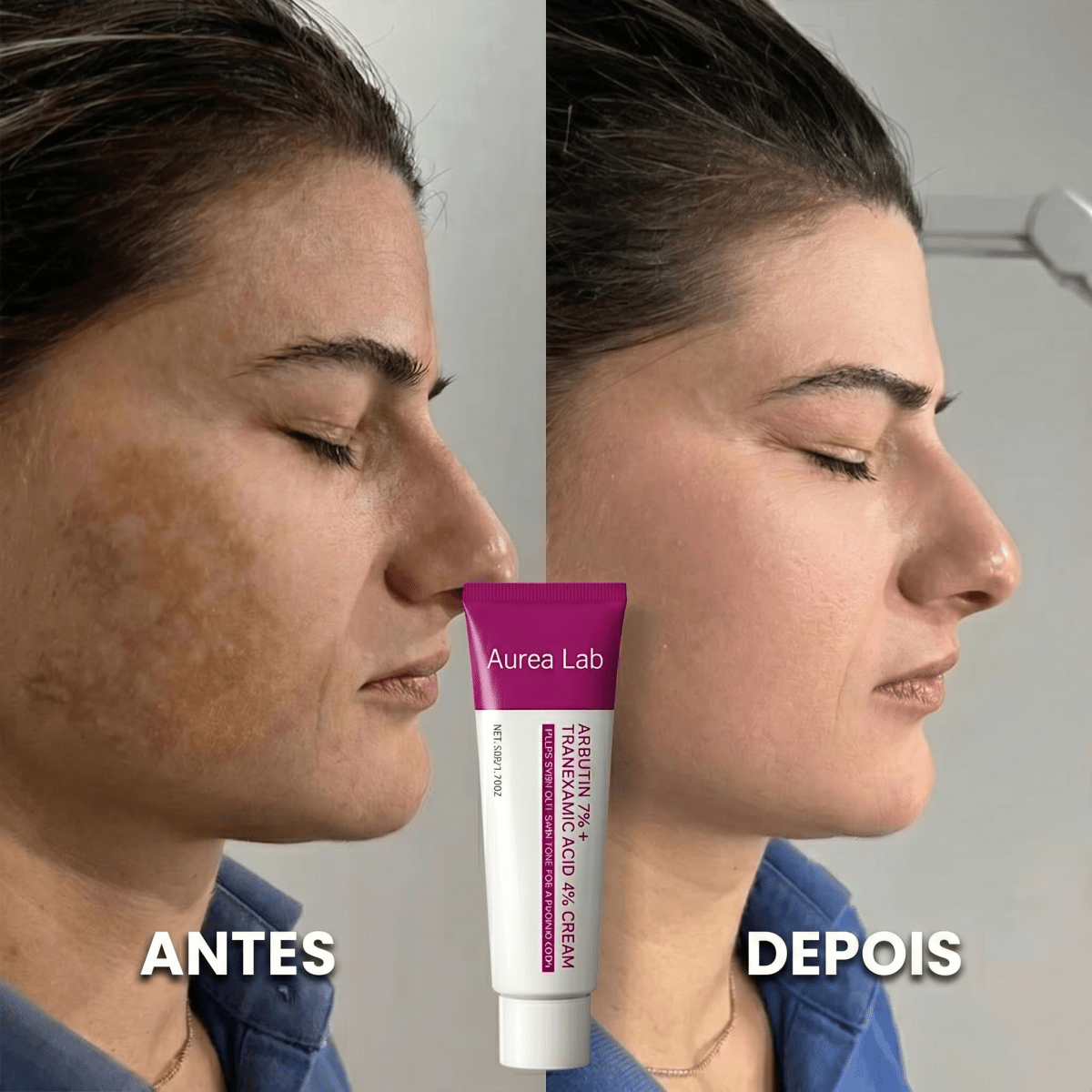 Melasma - antes e depois perfil